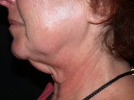 Before neck lift