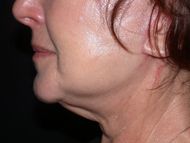 After neck lift