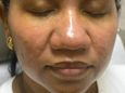 Chemical peel patient