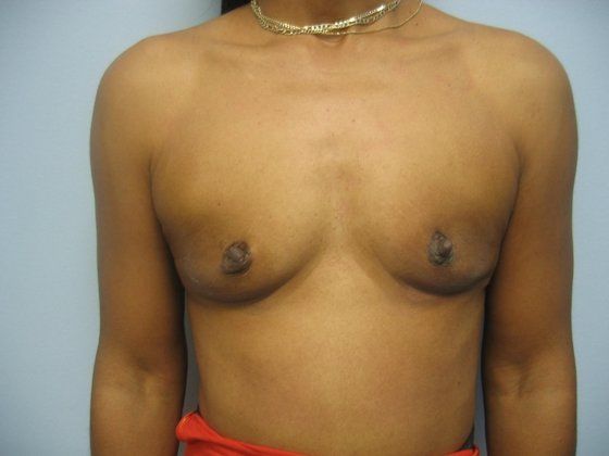 Before breast augmentation