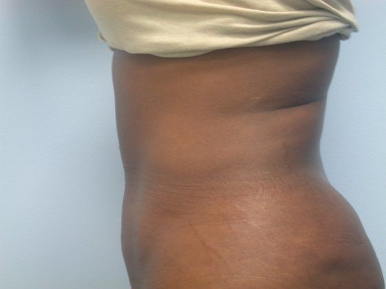 After liposuction